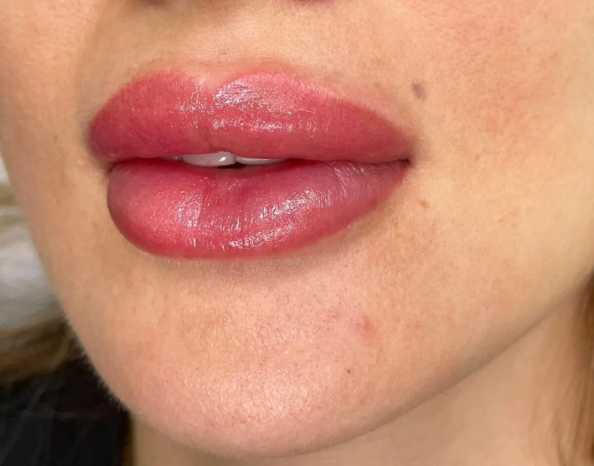 Benefits of Lip Neutralization